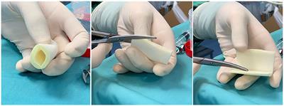 Evaluation of a New Tubular Finger Oxygen-Enriched Oil Inside-Coated Dressing Device in Pediatric Patients Undergoing Distal Hypospadias Repair: A Prospective Randomized Clinical Trial Part II